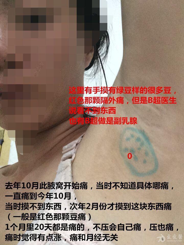 副乳?皮脂腺?