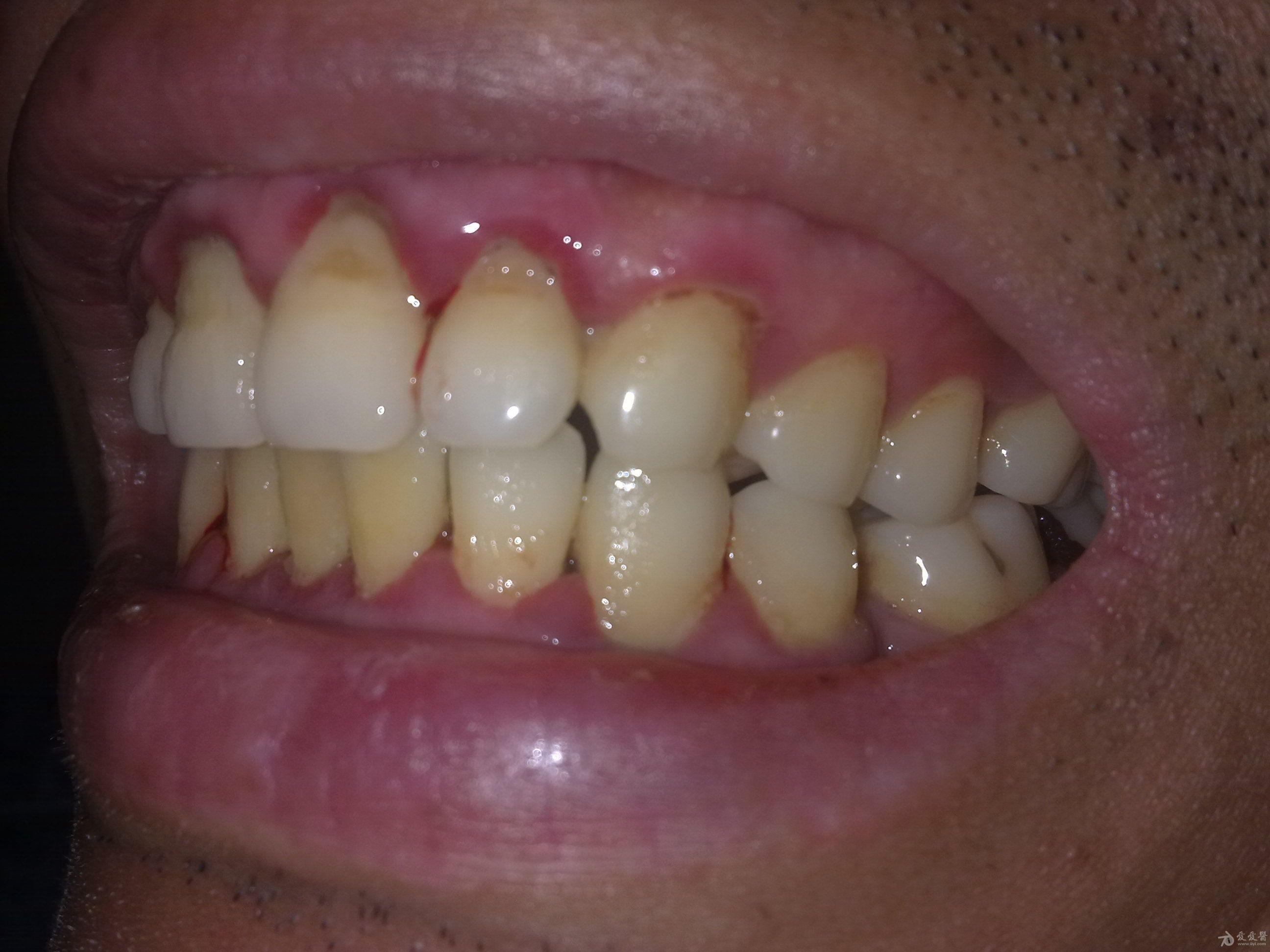 上下门牙牙龈红肿,出血半年多,求怎么治疗(有实拍图片)