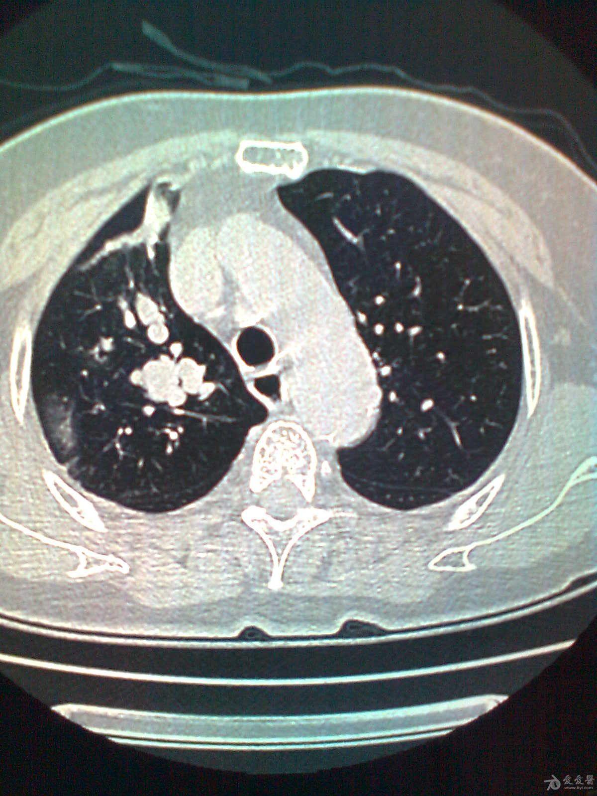 右肺条索状改变