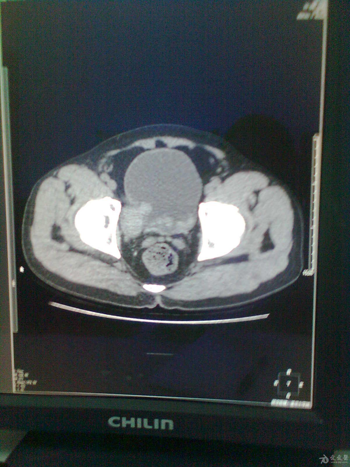 膀胱囊肿CT图片