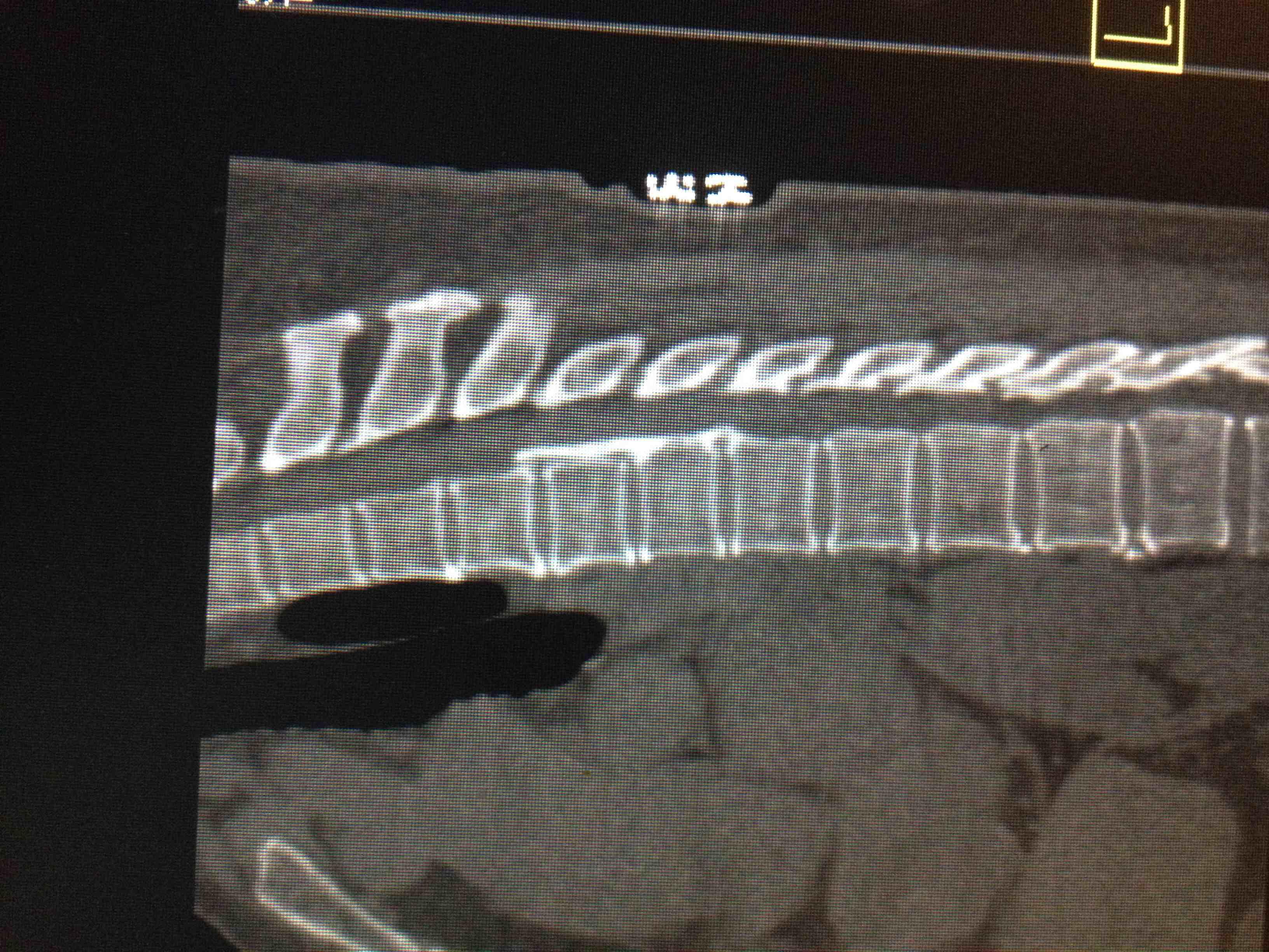 颈椎项韧带钙化图片ct图片