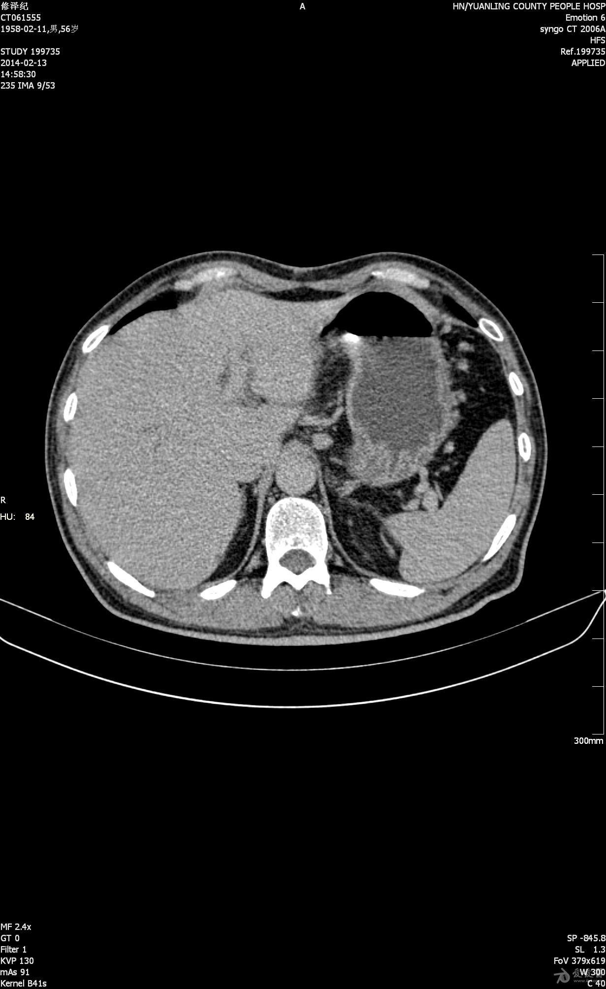 胰头部囊性灶图片