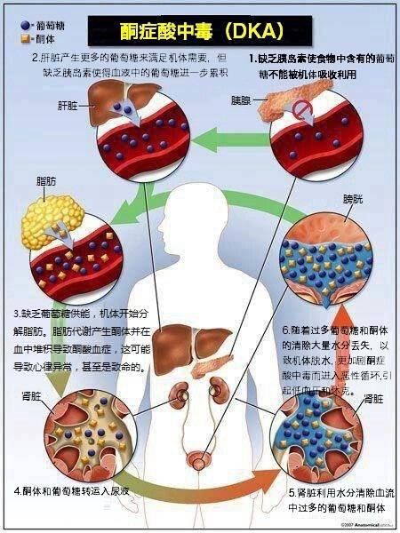 复习一下酮症酸中毒!