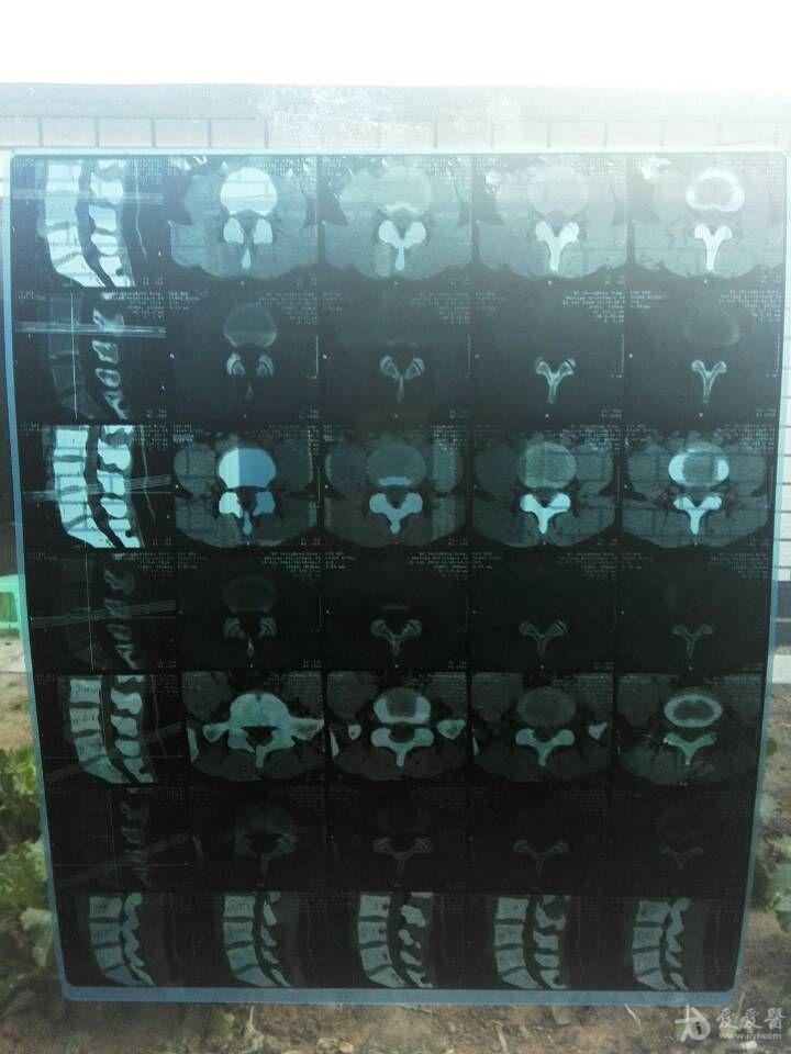 这个ct片子 l5/s1有没有骨质增生