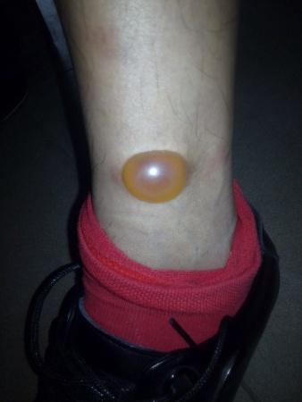 18:25:10 沙发回复lchlhltt2014-10-24 18:30:27丘疹性荨麻疹 板凳