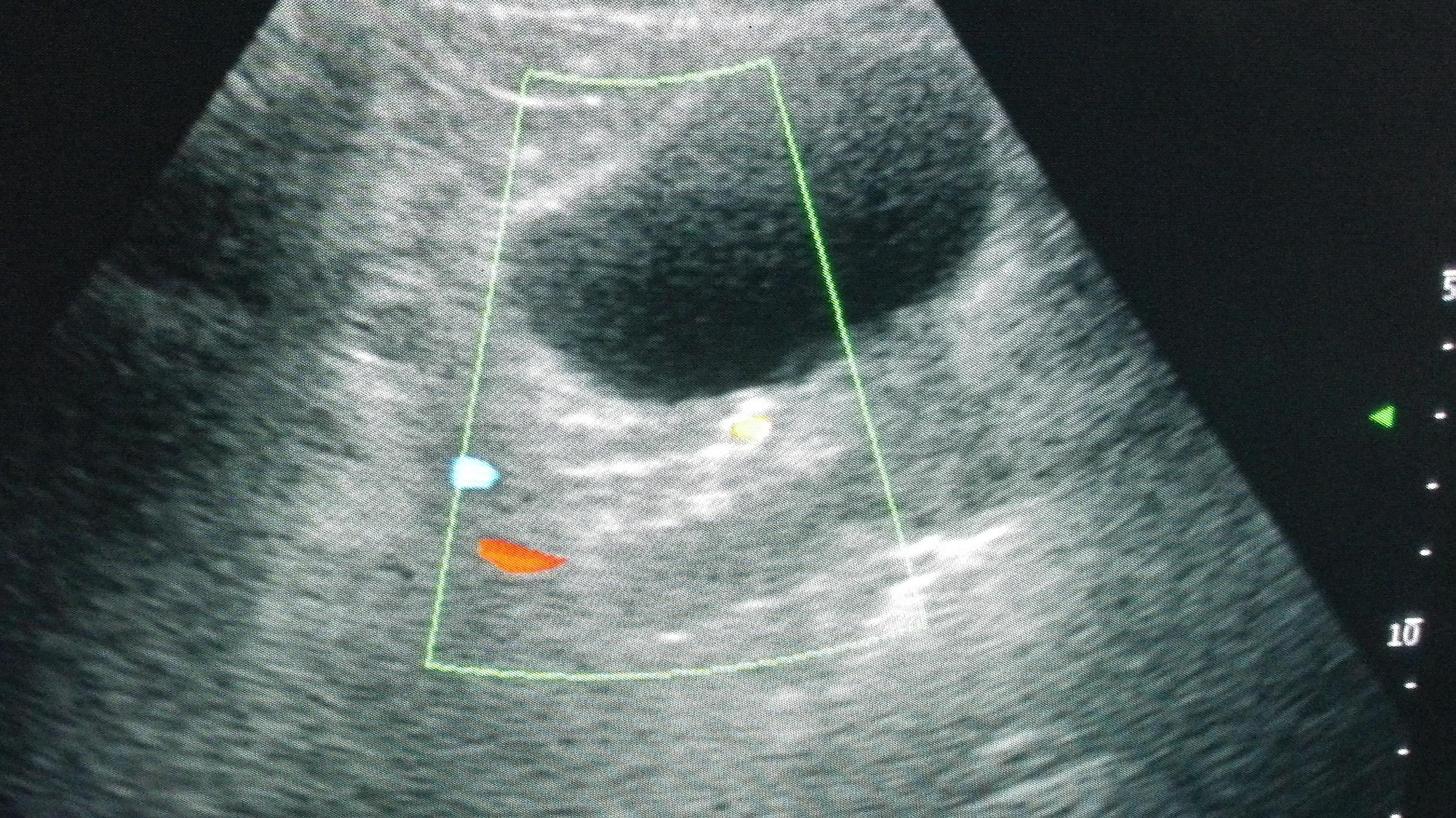 泌尿系结石 - 超声医学讨论版 - 爱爱医医学论坛 - 爱爱医医学网