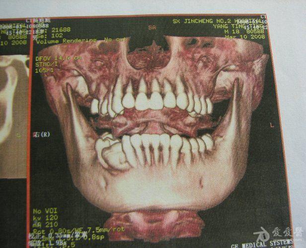 牙骨质瘤影像图片图片