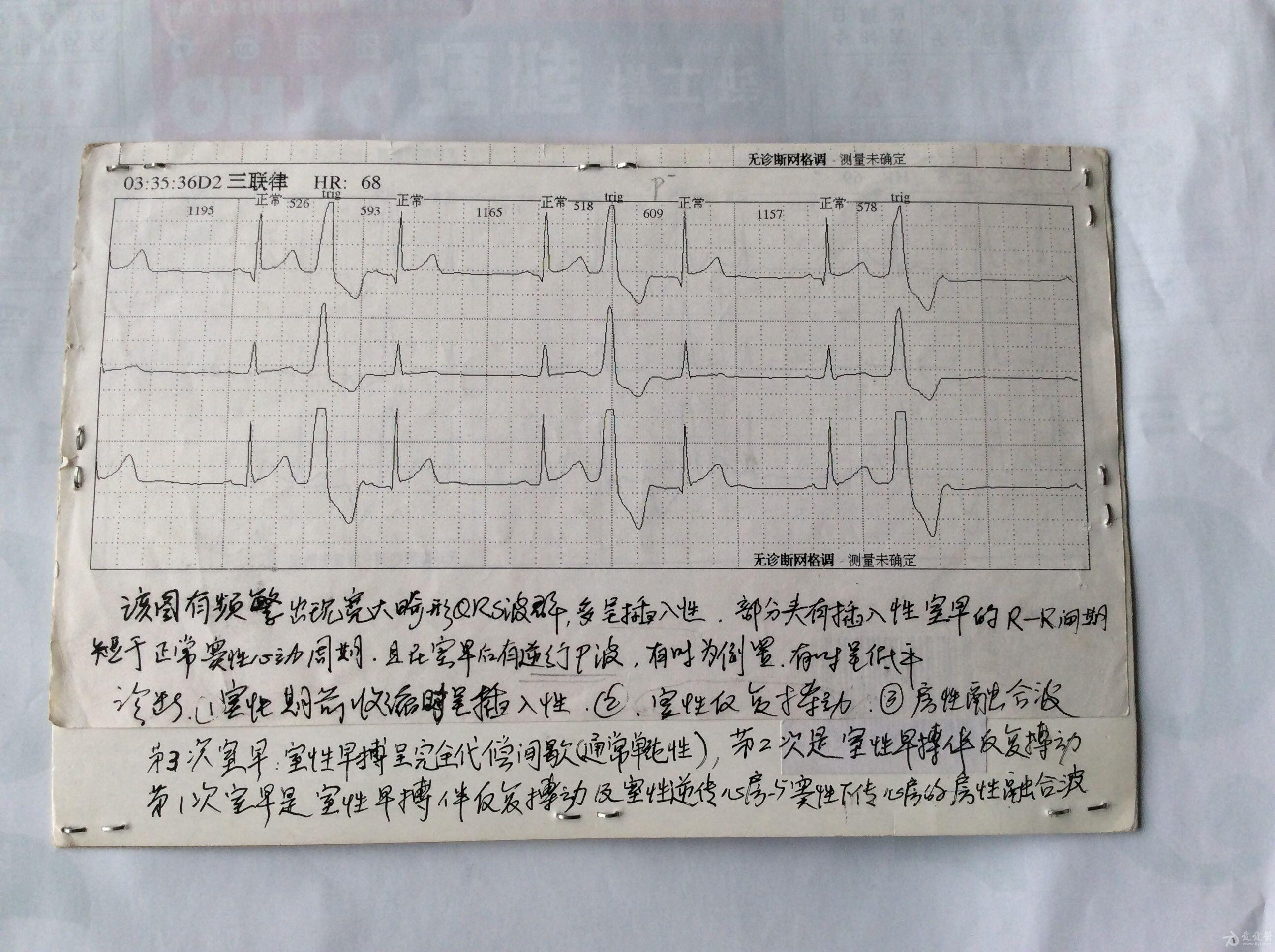 室性早搏代償間期幾種分析判斷方法(個人經驗)重新編輯 - 心電圖腦電