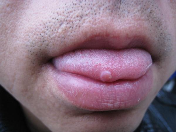 hpv感染 舌头图片