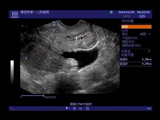 巧克力囊肿--------超声入门贴382(阴超的魅力)