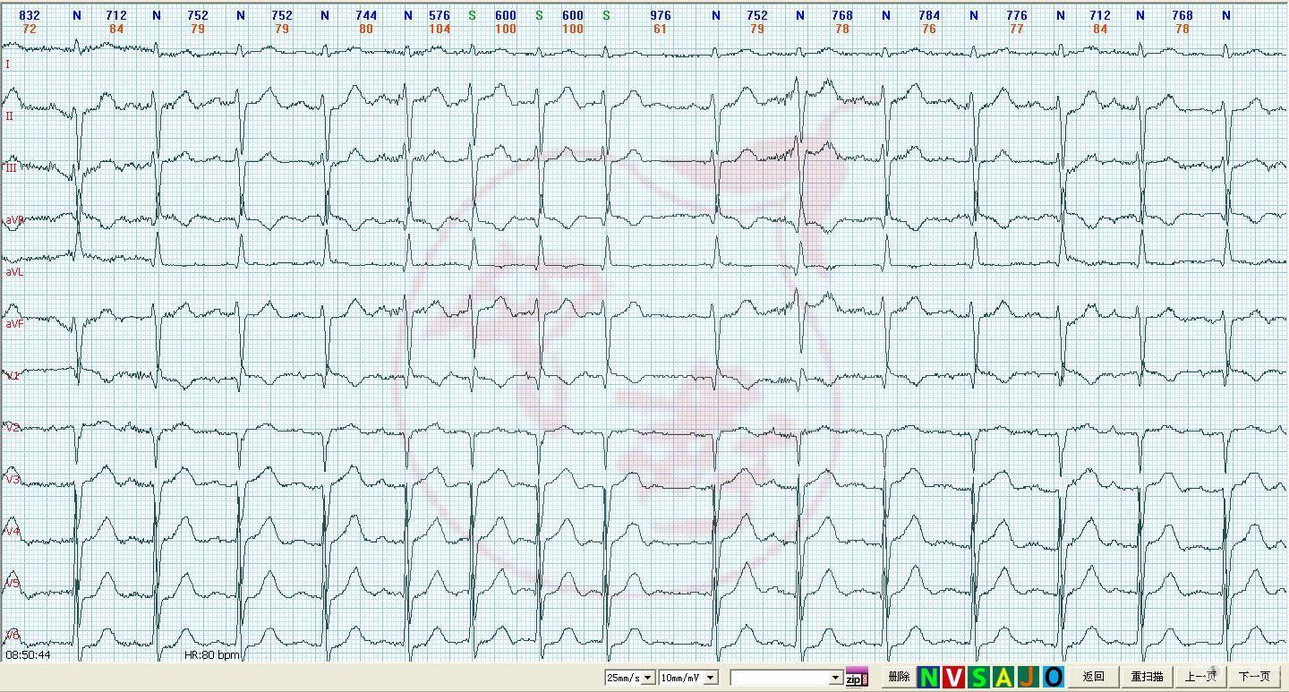 心电图学习20141206 p波?干扰?