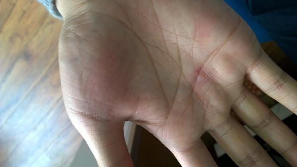 手掌发小水泡,会自行消退,但又反复,求咨询