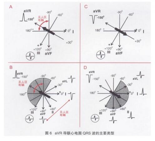 无人区电轴心电图识别图片