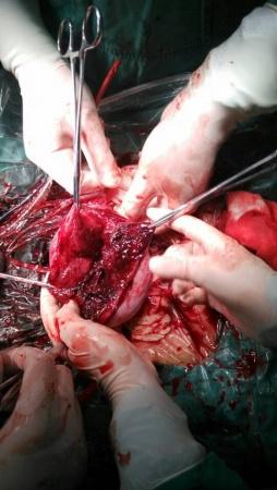 纵隔子宫宫腔镜术后妊娠晚期自发性子宫破裂1例