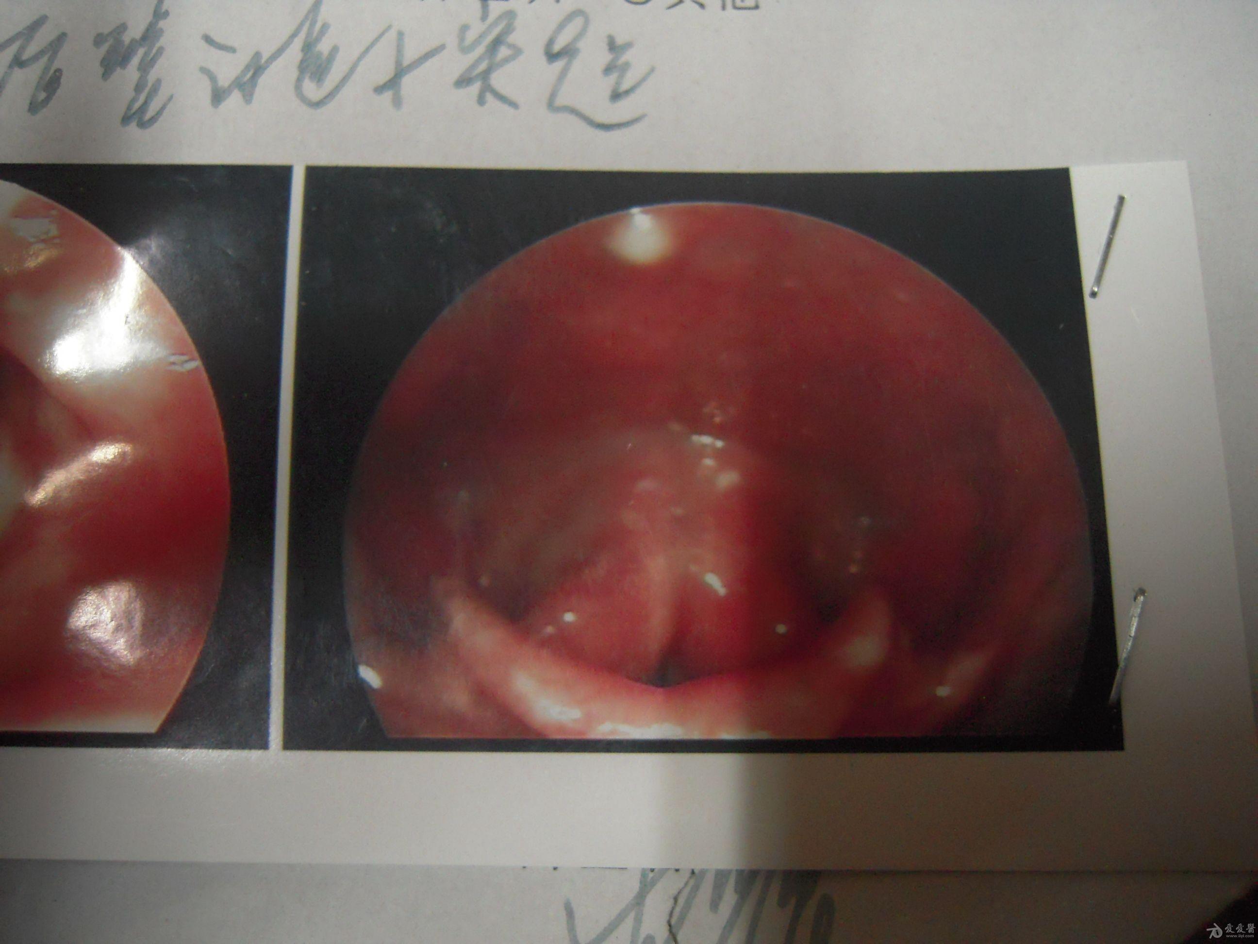 咽喉劈裂的位置图片图片
