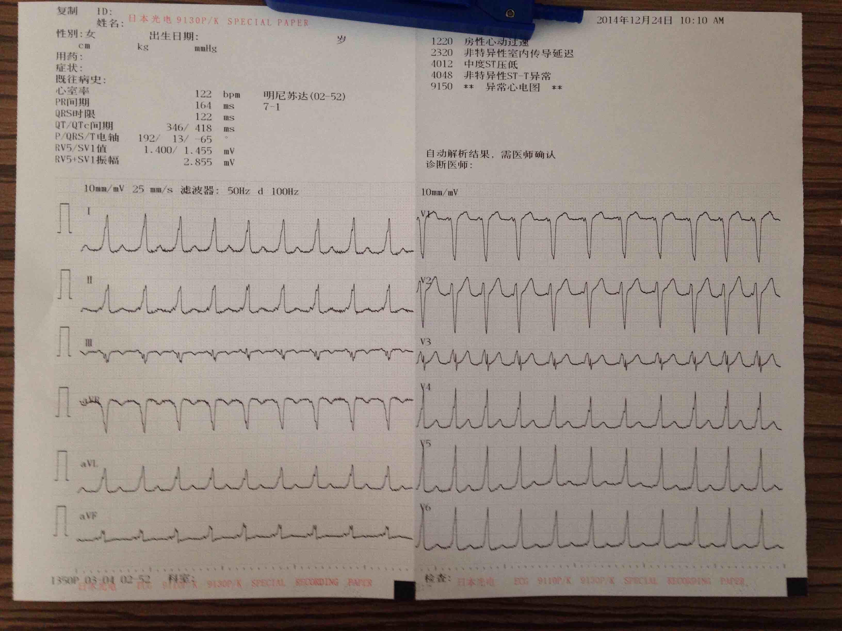 预激综合征b型图片