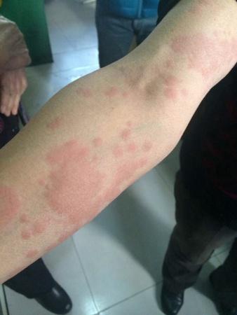 身体各处出现如图丘疹,高处皮肤表面,瘙痒,按荨麻疹治疗两天稍微减轻