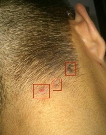 一样   有点黑 微突出于皮肤      右一 右二图中的  ,到底是  毛囊炎