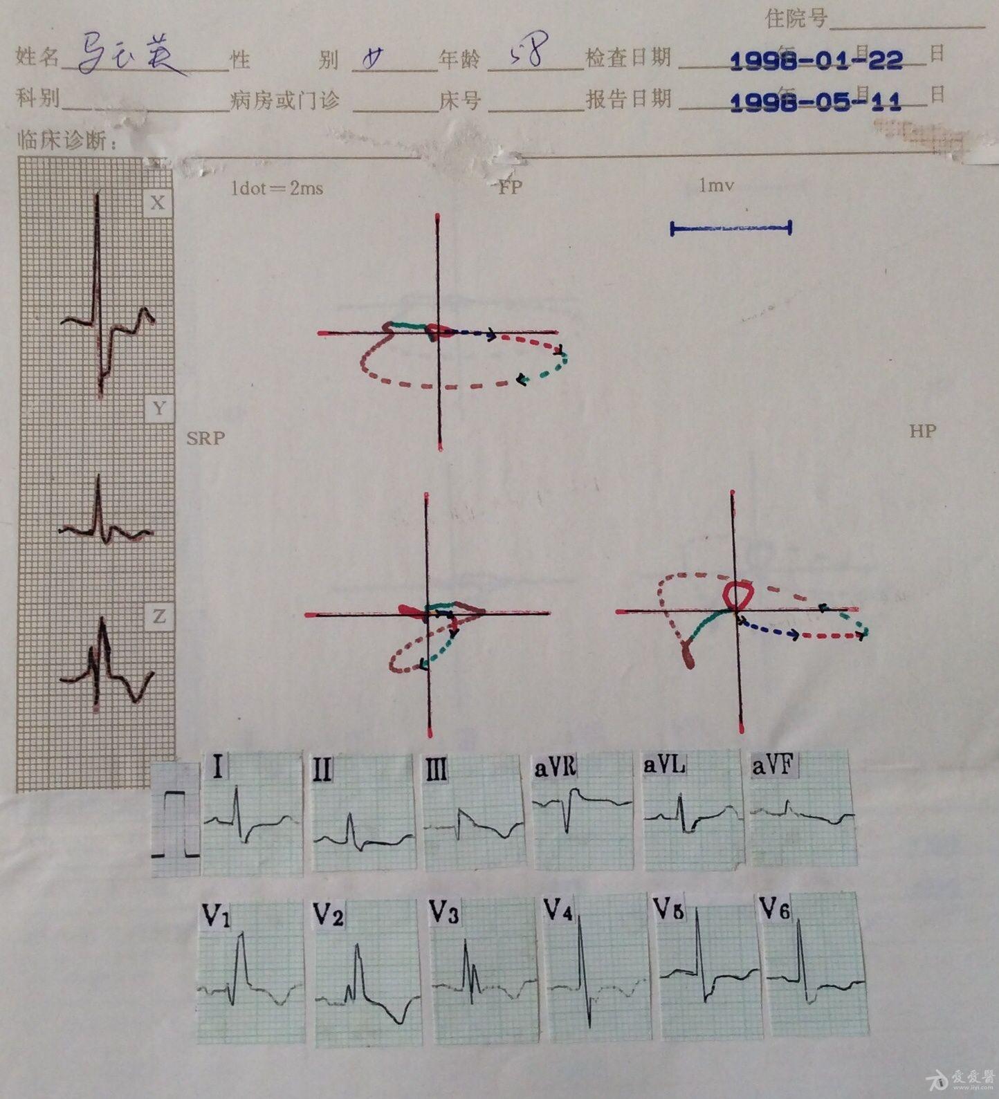 心电向量图图解 报告图片
