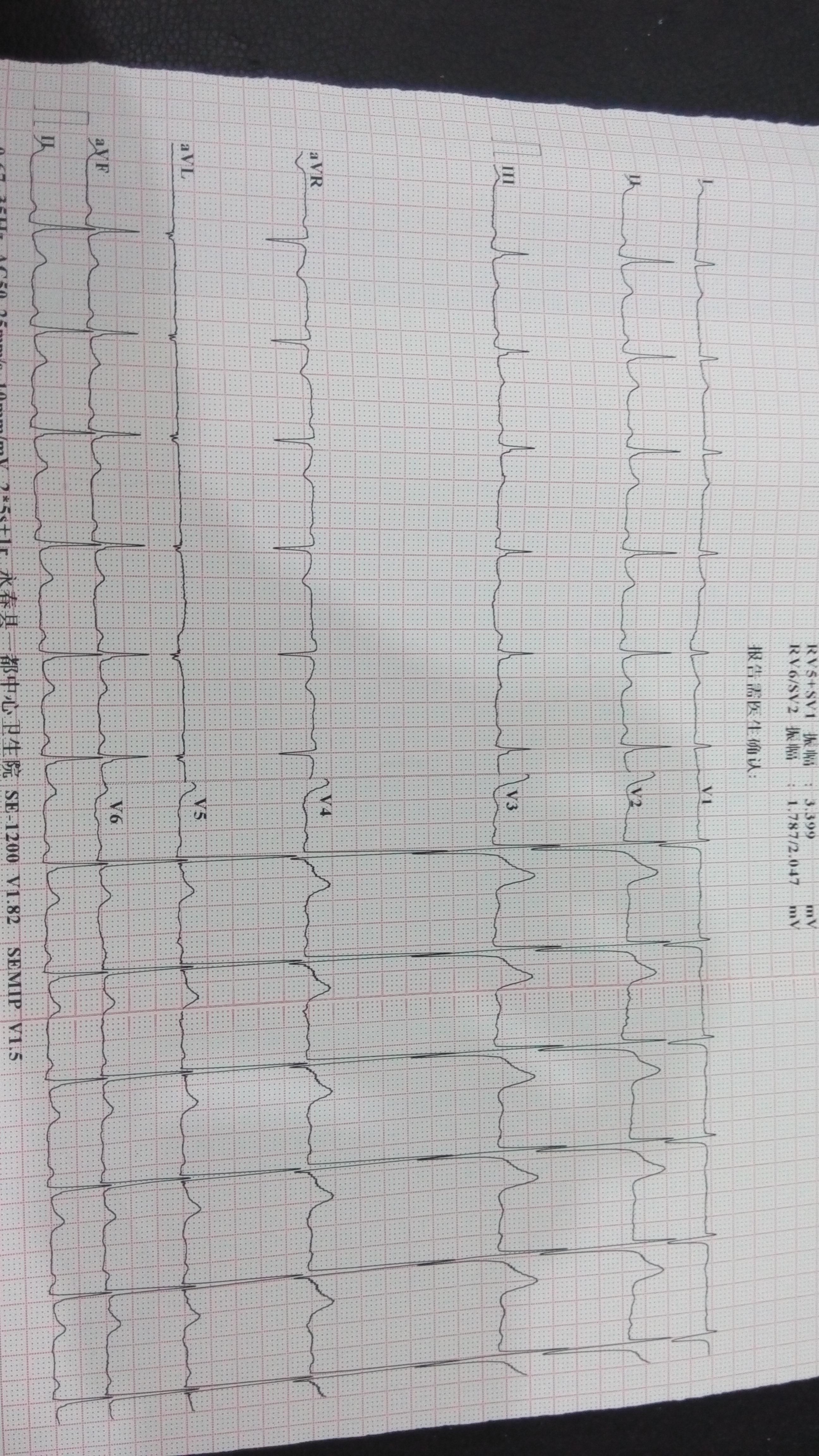 一张心电图