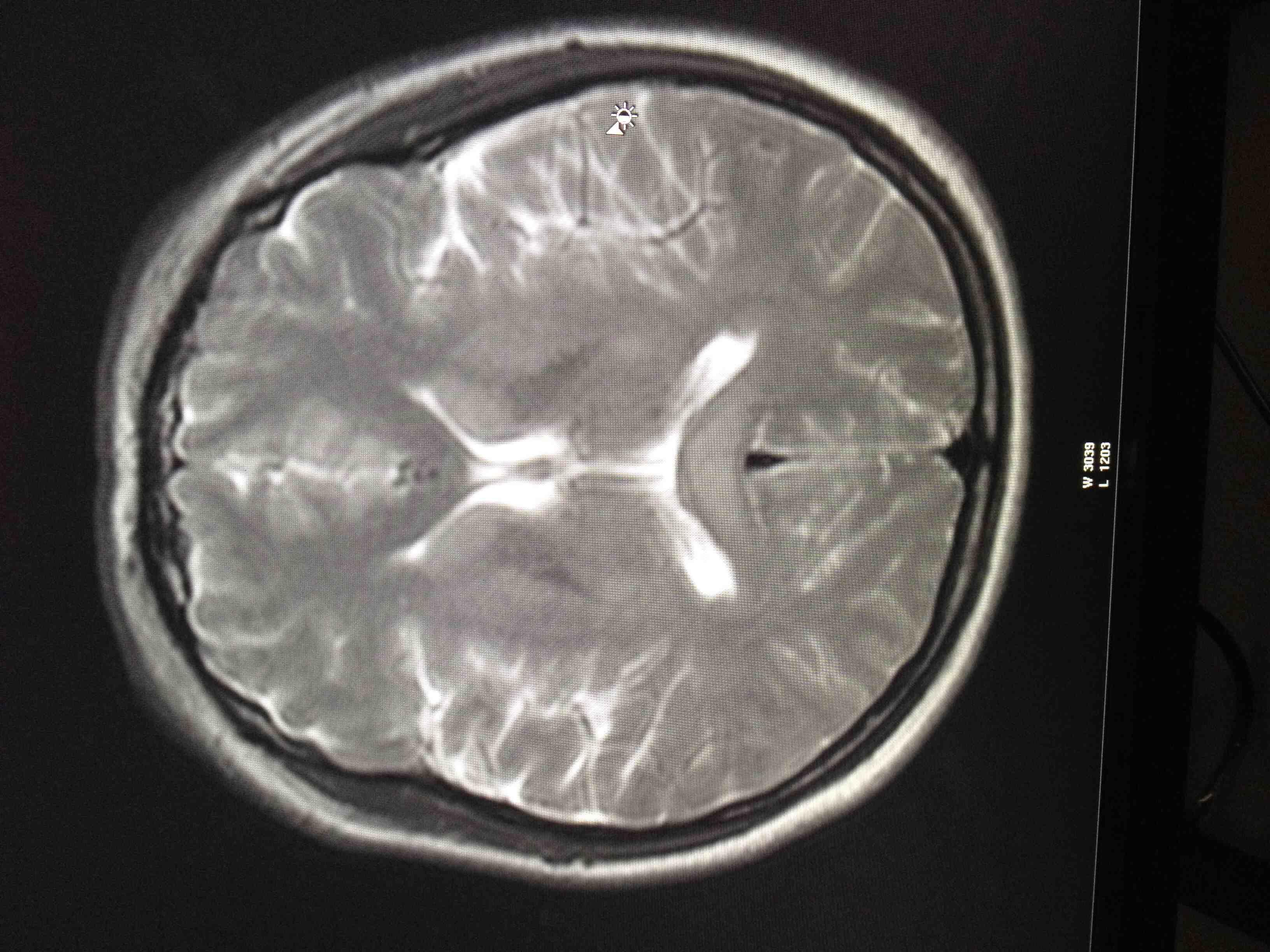 正常的脑部磁共振图片图片