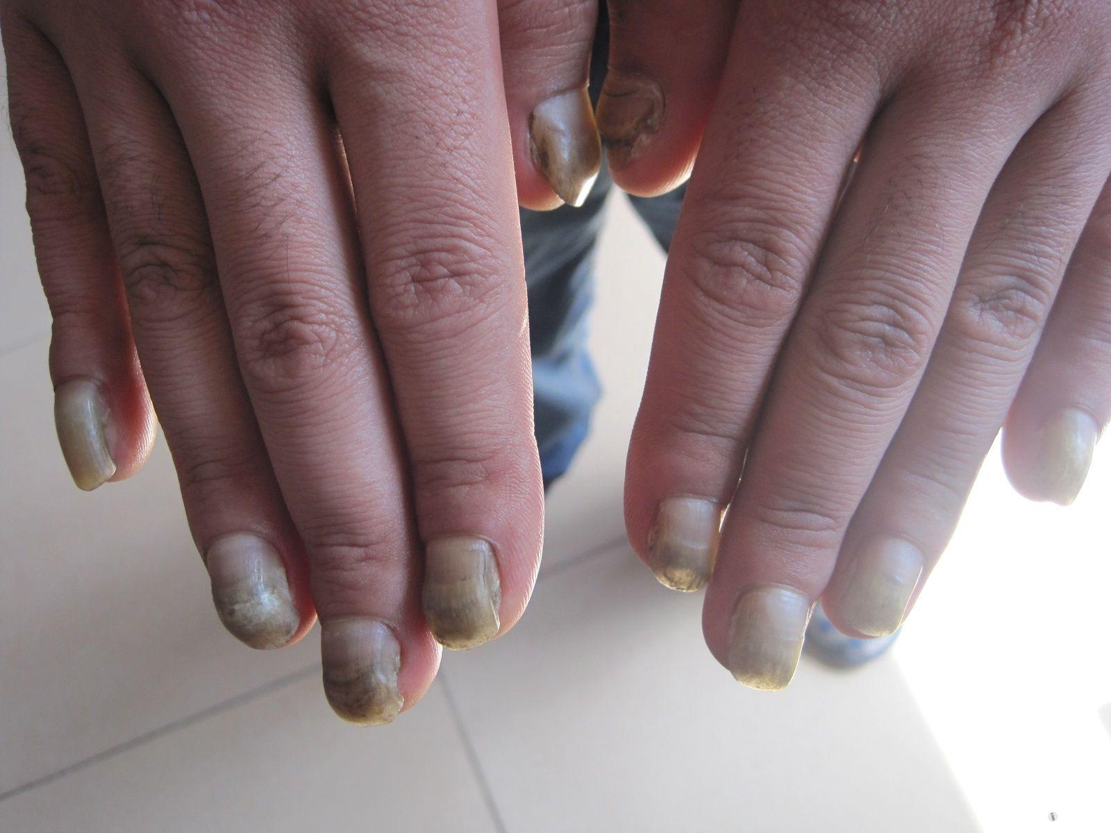 铅中毒指甲的症状图片图片