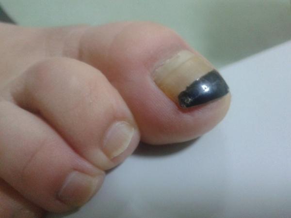 典型病例——甲分离