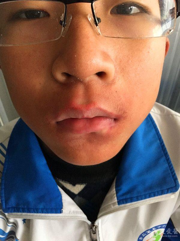 急性唇炎一例