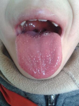 孩子脾虚引起草莓舌图片