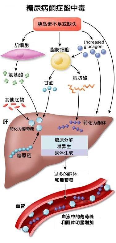 酮症酸中毒的表现图片