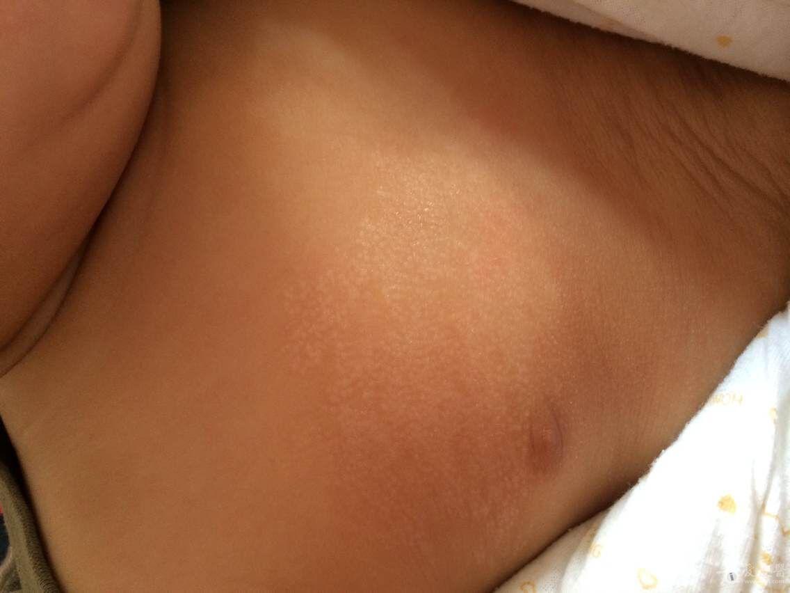 新生儿粟粒疹
