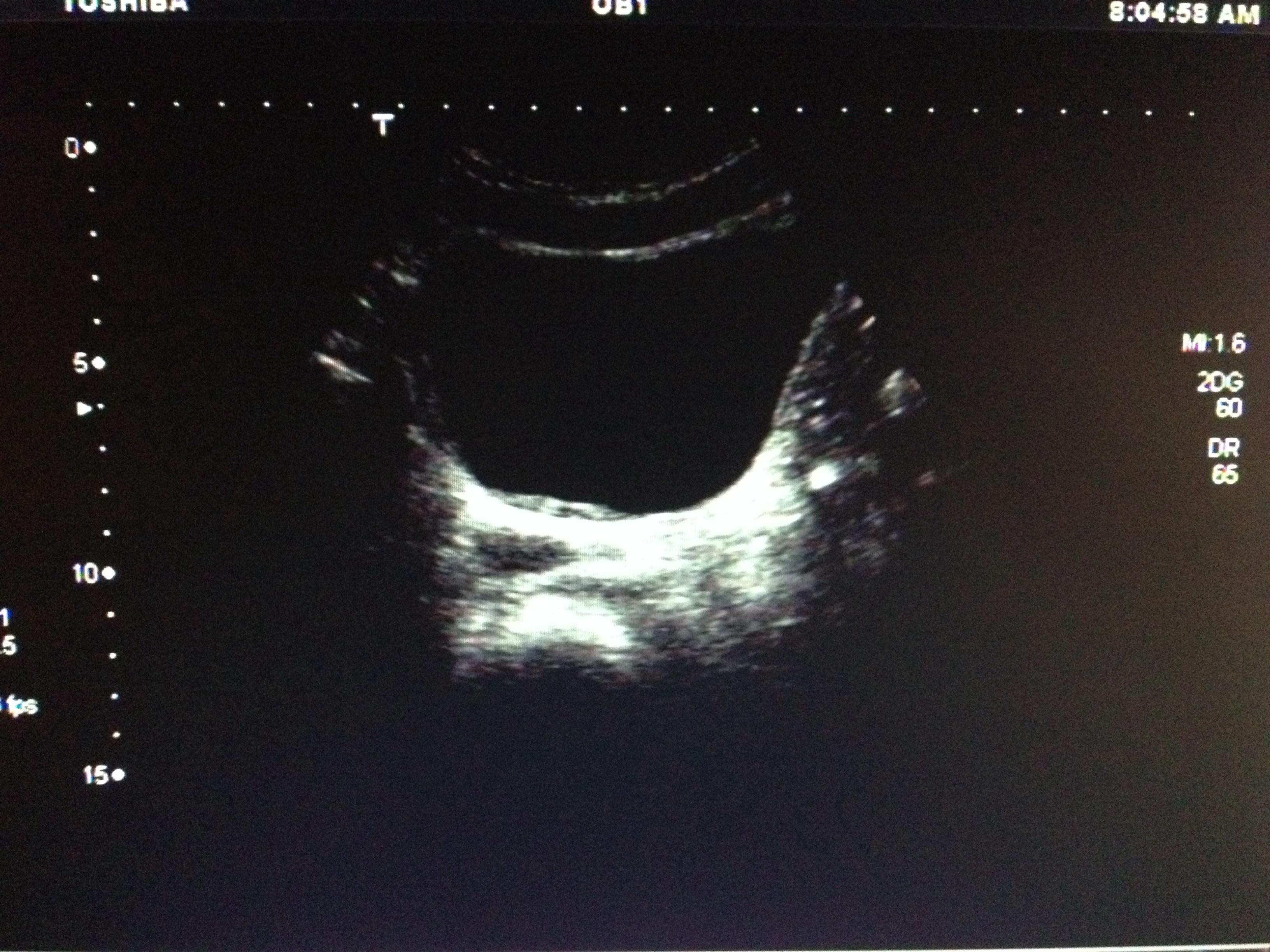 帮忙看看这个图片膀胱后壁内膜增厚吗