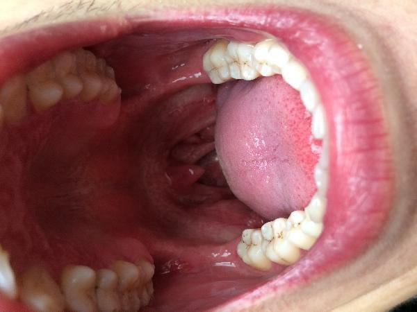 喉咙疣体图片