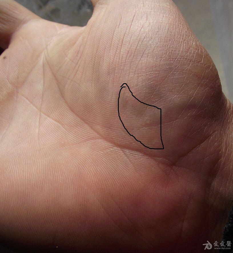 楼主乡村教员2015-03-01 15:26:48   以前龟头上有一个小白斑,有两个