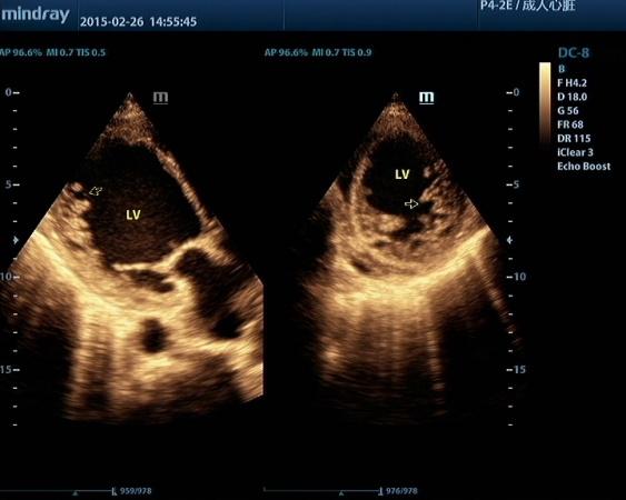 心肌致密化不全 - 超声医学讨论版 - 爱爱医医学论坛 - 爱爱医医学网