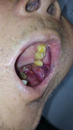 口腔瘤子图片 早期图片