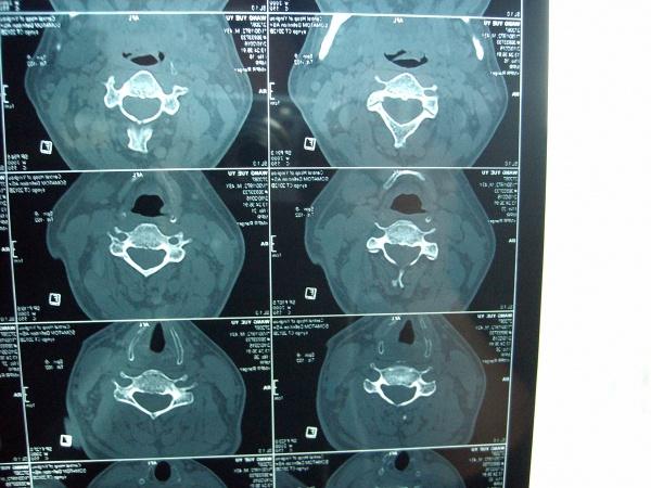 颈椎横突骨折图片