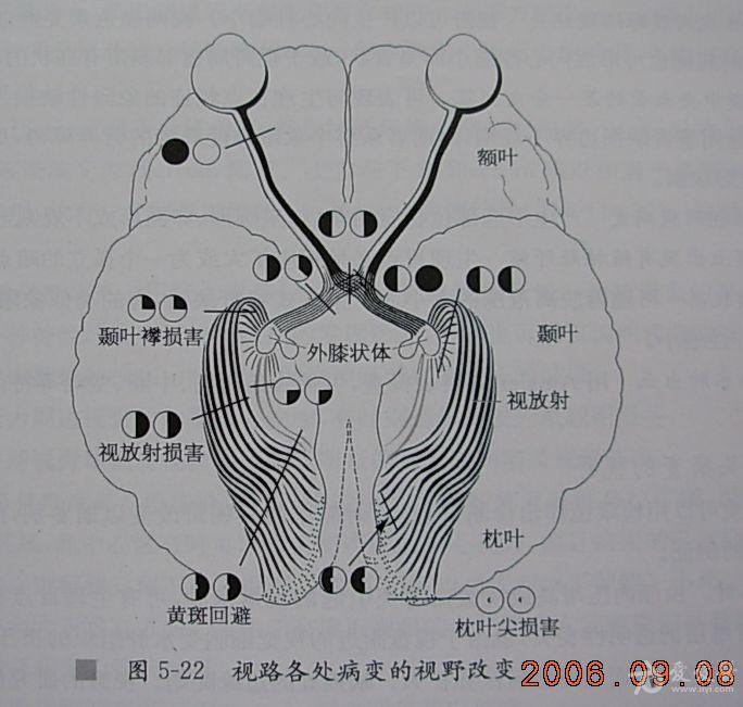 同向性偏盲图片