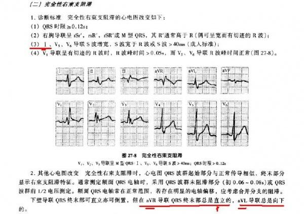 关于郭继鸿-心电图学:不完全性右束支阻滞 图例的一点疑问.