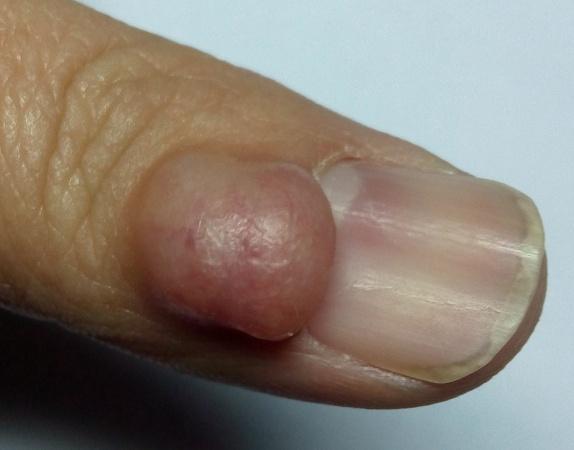 手指滑囊炎的症状图片图片