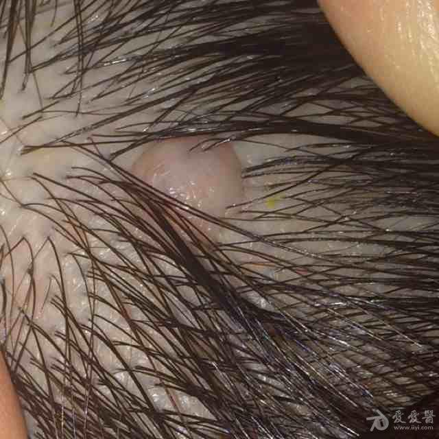 毛基质瘤图片