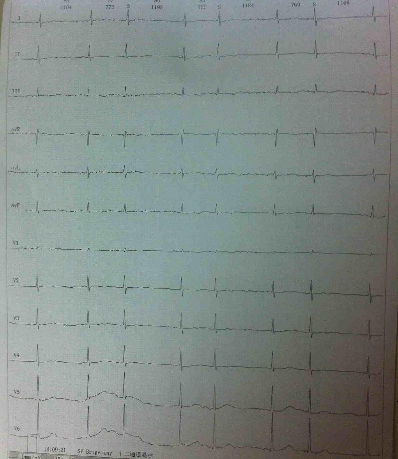 房早未下传心电图图片图片