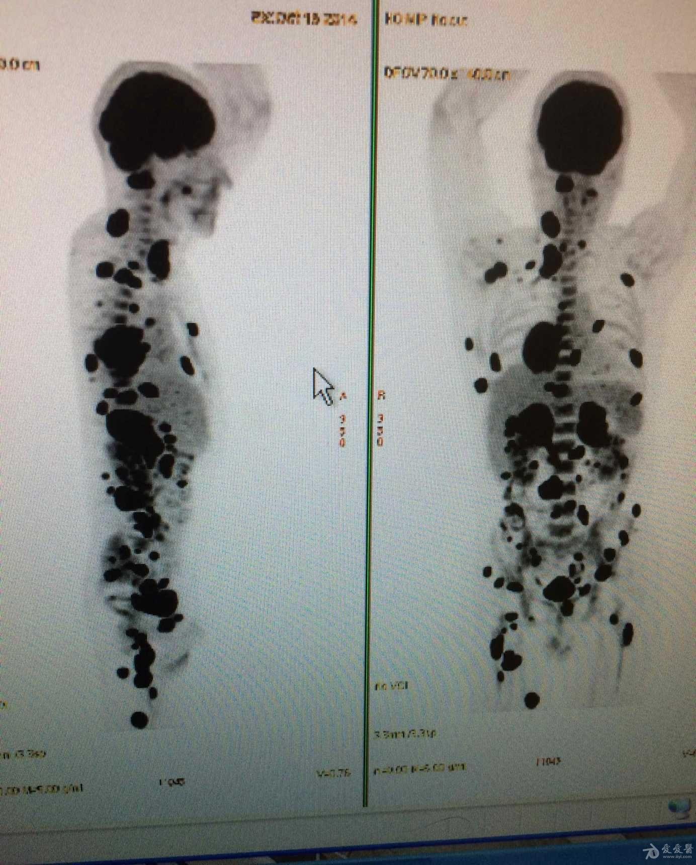 男,运动员,无病史,刚被诊断出肺癌,这是他的pet扫描图,这是全身都转移