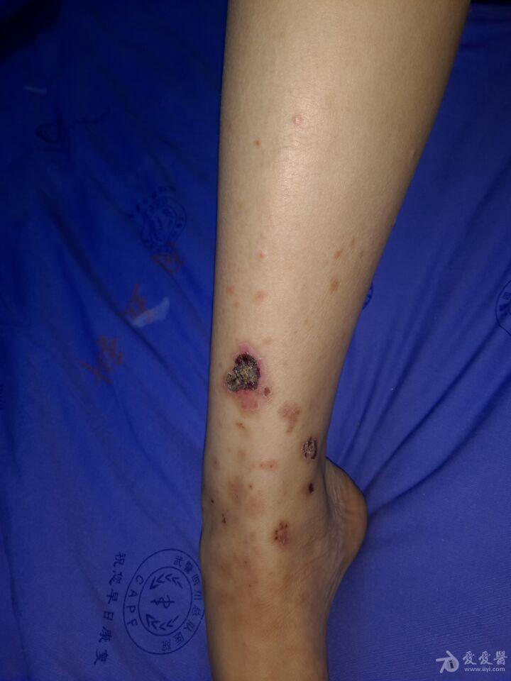 现在考虑变应性皮肤.