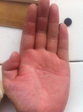 手心热,手掌脱皮