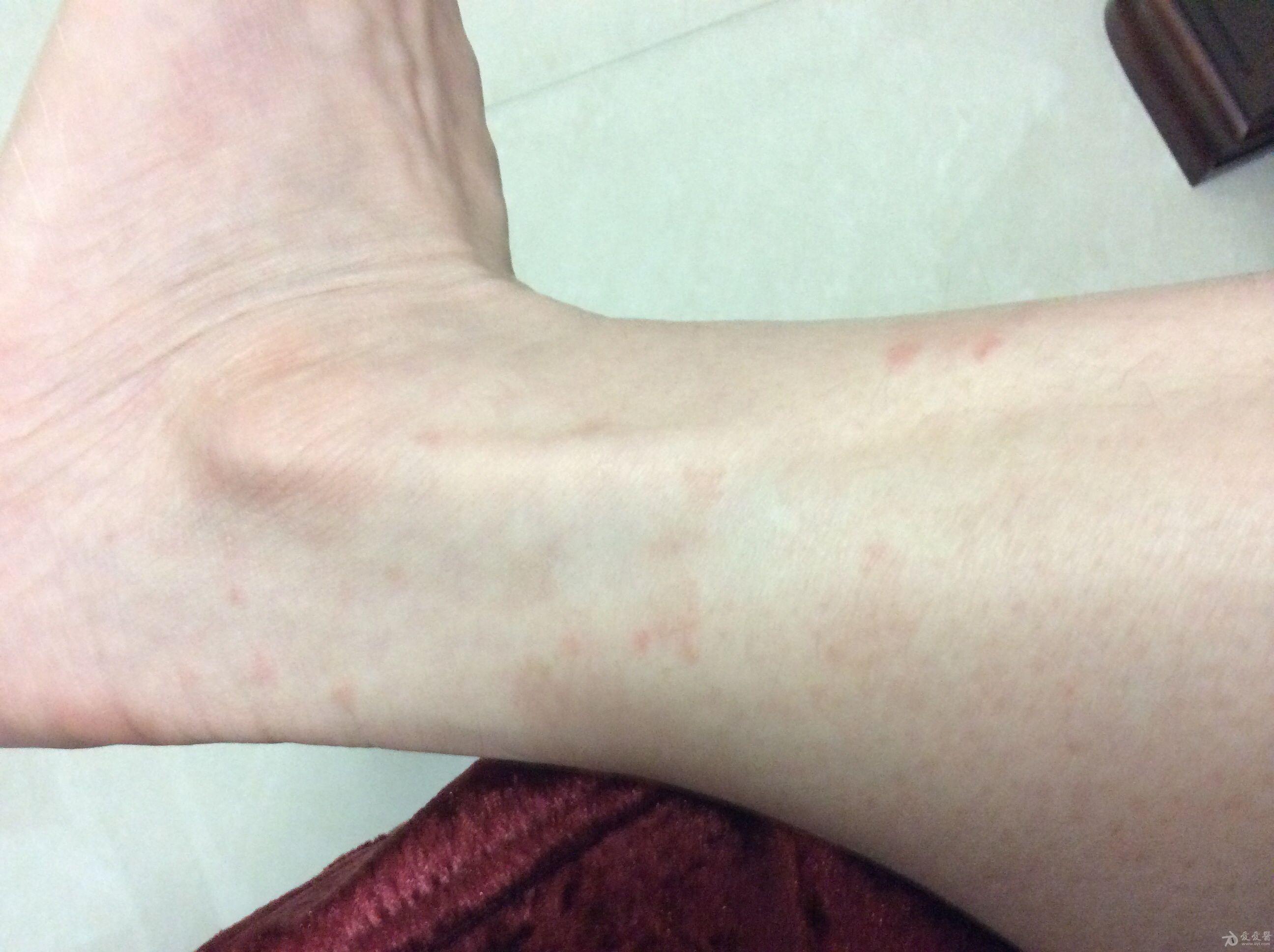 4楼回复linziyan1686天前看起来像汗癣,用酮康唑试试看  5楼回复无限