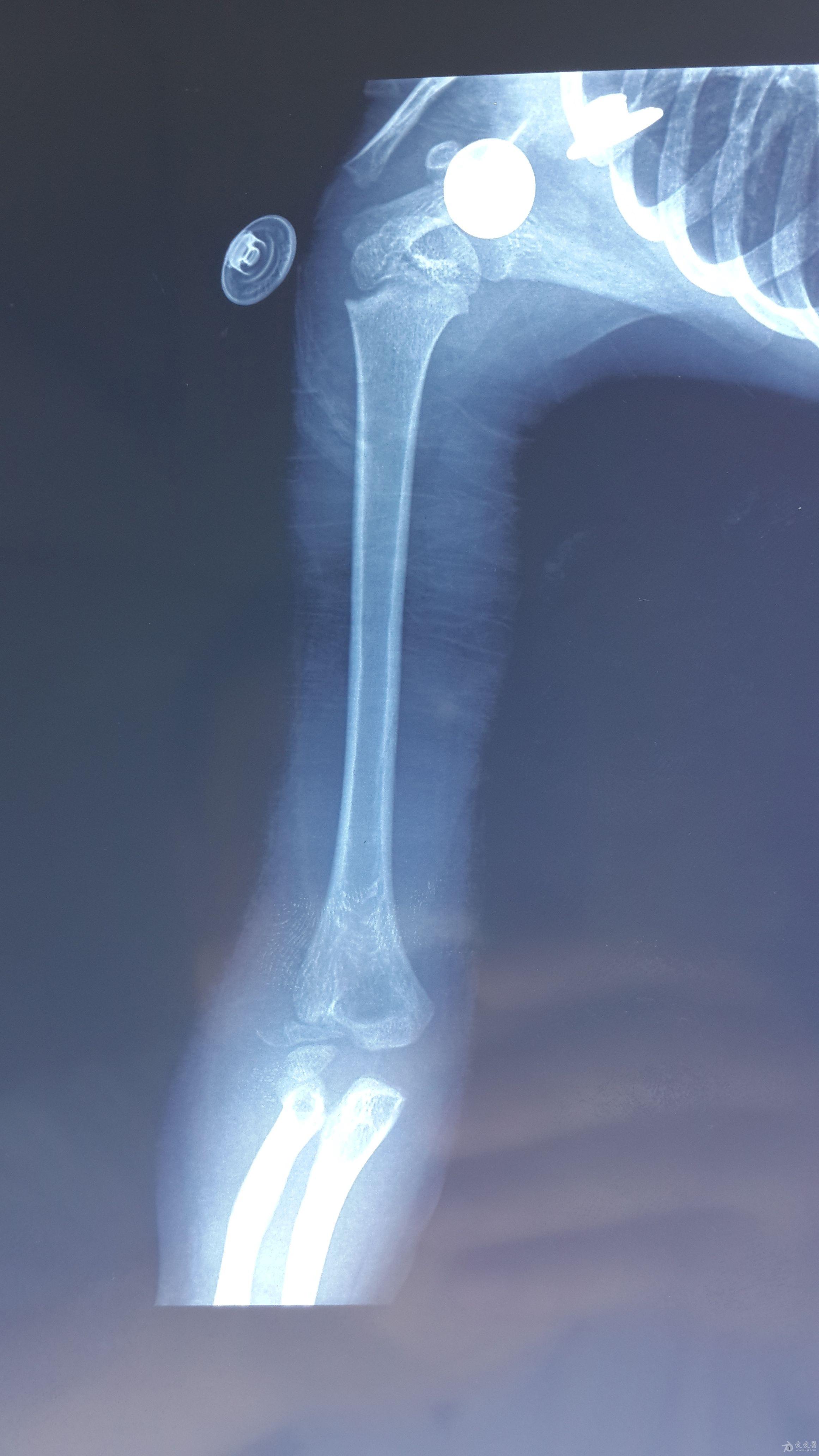 正常肱骨x线图片图片