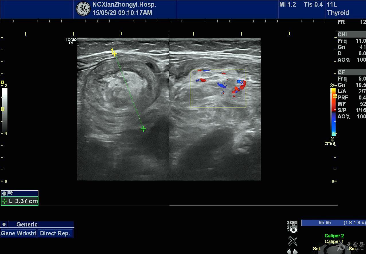 肠套叠 - 超声医学讨论版 - 爱爱医医学论坛 - 爱爱医医学网