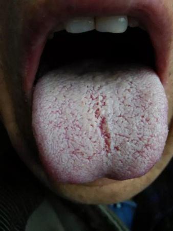 运用余晓辉舌诊辩证治疗胃炎一例