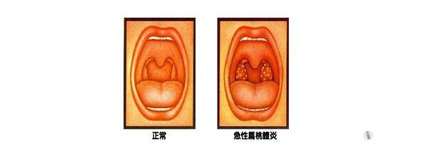 腭舌弓变白图片